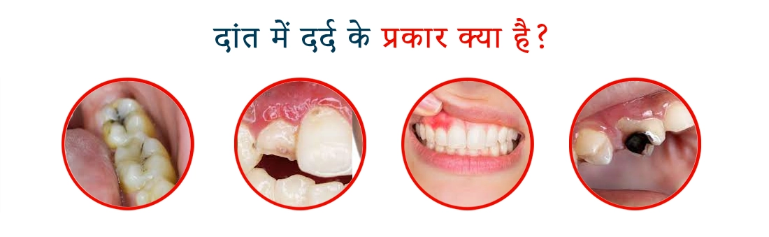 दांत दर्द (Toothache) एक आम समस्या है, लेकिन बहुत तकलीफदेह हो सकती है। यहां कुछ घरेलू उपाय दिए गए हैं जो दांत दर्द में राहत दे सकते हैं: