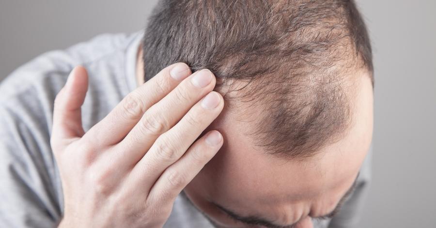 बाल गिरने का कारण और उपाय (Hair Fall Causes and Remedies in Hindi)