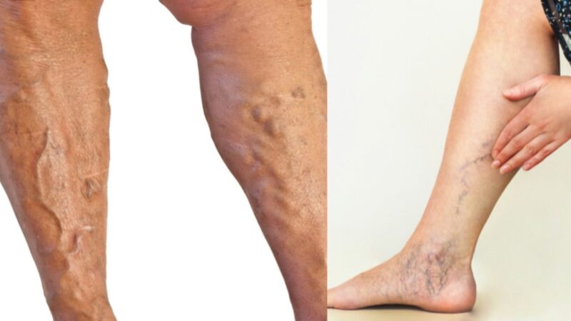 नसों की बीमारी (Nerve Disorders / Neurological Problems) से जुड़ी समस्याएँ शरीर के किसी भी हिस्से को प्रभावित कर सकती हैं